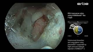 ESD of a LSTNG tumor at the splenic flexure using HYBRIDknife® flex IType [upl. by Aivuy740]