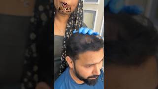 Dandruff treatment full video uploaded dandruff [upl. by Rahman792]