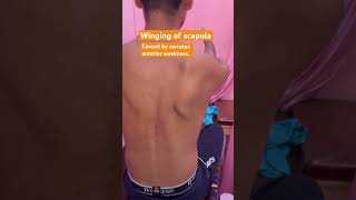 Winging of scapula scapula serratusanterior winging drshubh [upl. by Ellened]