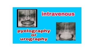 Intravenous Pyelography  Urography IVP  IVU [upl. by Mcdougall]