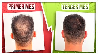 RECUPERA SU PELO en 3 MESES con DUTASTERIDE y MINOXIDIL ORAL [upl. by Eidolem]