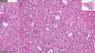 Prostatic Adenocarcinoma  Histopathology [upl. by Patman40]