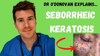 Explaining Seborrheic Keratosis  With Dr ODonovan [upl. by Atteiram]