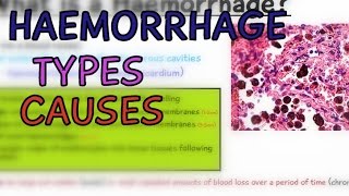 Pathology Lectures Haemorrhage Types and Causes Hemorrhage  EXPLAINED IN 4 MINUTES [upl. by Ainevuol]