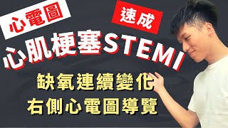 【8分鐘搞定心肌梗塞心電圖】STEMI ECG實際案例導覽！心肌梗塞臨床症狀、右側心電圖判讀、ACLS、前壁梗塞、側壁梗塞！醫學生臨床值班必備技能！心肌缺氧連續性心電圖變化、十二導程心電圖、課後測驗！ [upl. by Calvinna]