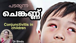 കണ്ണു സൂക്കേട് ചെങ്കണ്ണ് വന്നാൽConjunctivitis in childrenDr Bindu childcare tips [upl. by Larissa]