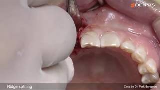 DENTIS Implant Ridge splitting by mass and chlsel bone graftCGF sling suture [upl. by Ayikan]