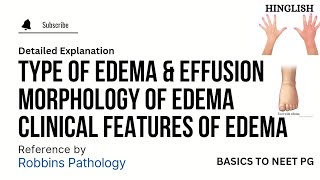 Edema Oedema  Part 3  Types of Edema  Morphology of Edema  Clinical Feature of Edema KTC MBBS [upl. by Acemat]