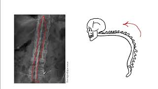 Video 188 Seronegative Spondyloarthritis Psoriatic Arthritis Ankylosing Spondylitis amp More [upl. by Grover]