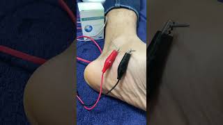 Dry needling  Tendinite de jambier posterieur douleur au pied [upl. by Saihtam]