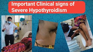 Severe Hypothyroidism Important Clinical signs [upl. by Manlove]