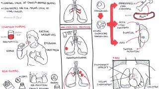 Lung Cancer  Overview [upl. by Attelrac496]