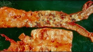 Atheroma  Pathology mini tutorial [upl. by Maureen]