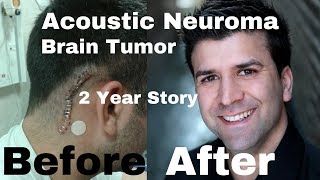 Acoustic Neuroma  My experience of a brain tumor amp brain surgery 30min [upl. by Rebmyk]