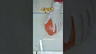 Ovarian cyst specimen [upl. by Yelhs]