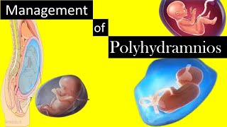 Management of Polyhydramnios [upl. by Valma279]