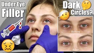 Under Eye Filler Injection for DARK CIRCLES  Alexandra Anele [upl. by Ellednek]