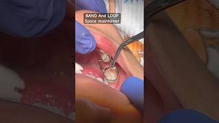 BAND amp LOOP Space maintainer oralhealth viral trending youtubeshorts kidsdentitryshorts brac [upl. by Seyler22]