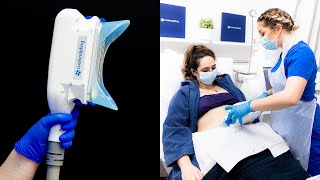 Is CoolSculpting worth it  Before and After Results [upl. by Esilrahc]