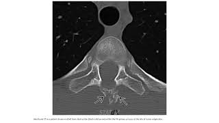 Ewing Sarcoma Imaging [upl. by Constantia]