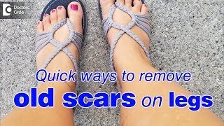 How to remove old scars on legs fast  Dr Rasya Dixit [upl. by Anu]