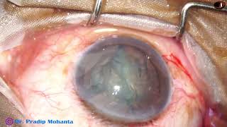 Use of Prechopper in a cataract with 5 clock hours of Zonular Defect Pradip Mohanta 29July 2024 [upl. by Aihseuqram263]