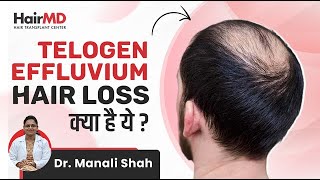 क्या है Telogen Effluvium Hair Loss  Reasons for Telogen Effluvium  HairMD Pune [upl. by Droffig]