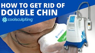 Double Chin Fat Reduction using CoolSculpting [upl. by Eeslek]