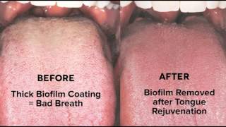 Tongue Rejuvenation  Cure Bad Breath Biofilm amp Halitosis 7035330927 [upl. by Ile]