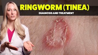 Ringworm Tinea  Diagnosis Treatments and Home Tips from a Dermatologist [upl. by Almond]