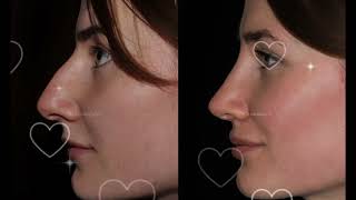 Virtual rhinoplasty [upl. by Eecats153]