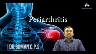 What is PERIARTHRITIS – SHOULDER PAIN What are its Remedies  by DrSuman CPS VGM Hospital [upl. by Chyou]