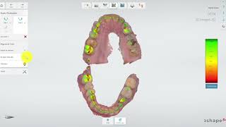 TRIOS 3shape occlusion settings flag adjust for contacts [upl. by Adnawat914]