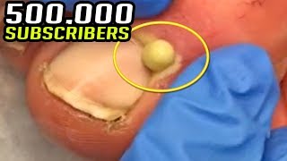 500000 Cysts Blackheads amp Ingrown Nails Thank You Video [upl. by Holub317]