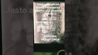 Isquemia mesentérica crónica resuelta por un Stent [upl. by Peper]