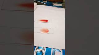 Making a peripheral blood smear  blood smear preparation  prepare a perfect blood smearHematology [upl. by Amberly]