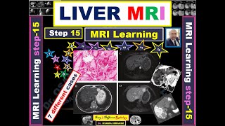 Liver focal lesions MRI learning 15 [upl. by Llewen]