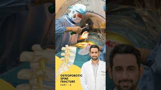 Treatment of Osteoporotic spine fracture  Dr Dheeraj Batheja  Part 2 doctor spinehealth [upl. by Edelman]