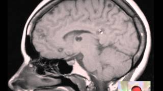 Cysticercosis multiple of Brain MRI DISCUSSION [upl. by Sybille]