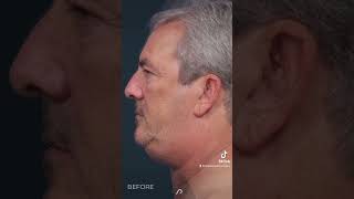 Watch the Incredible Results Neck Lift amp Liposuction Transformation [upl. by Lacombe]