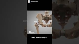 Total Hip Replacement surgery kese hoti hai  हिंदी  اردو  shorts [upl. by Sommer631]