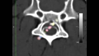 veterinary CT pet animal dog myelography [upl. by Atteirneh]