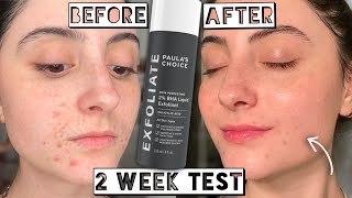 Testing Paula’s Choice 2 BHA LIQUID EXFOLIANT for Acne amp Scarring for 2 weeks [upl. by Nitsirc]