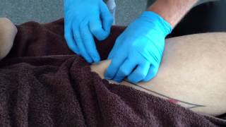 Dry Needling Rectus Femoris [upl. by Darill]