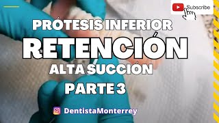 🔥🔥🔥 Prótesis INFERIOR👅ALTA SUCCIÓN Parte3 Resultado [upl. by Ellenoj]