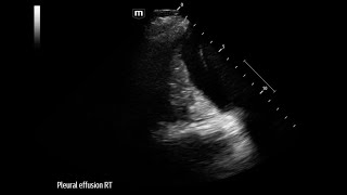 Parapneumomic Effusion Group A Strep Pyogenes Sepsis [upl. by Mairam]