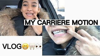 MY CARRIERE MOTION APPLIANCE  VLOG [upl. by Sonja]