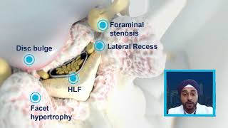 NYNJ Abstract  Mild Treatment Outcomes in the Presence of Foraminal Narrowing [upl. by Arehahs]