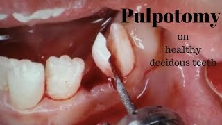 Pulpotomy on healthy Deciduous teeth [upl. by Ahsineb572]