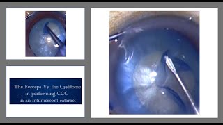 The Cystitome Vs the Utrata Forceps performing the capsulorrhexis in intumescent cataracts [upl. by Hercule]